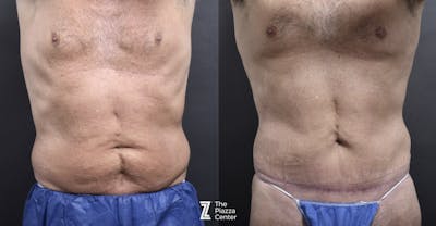 Austin Liposuction Before & After Gallery - Patient 182165 - Image 1 - The Piazza Center