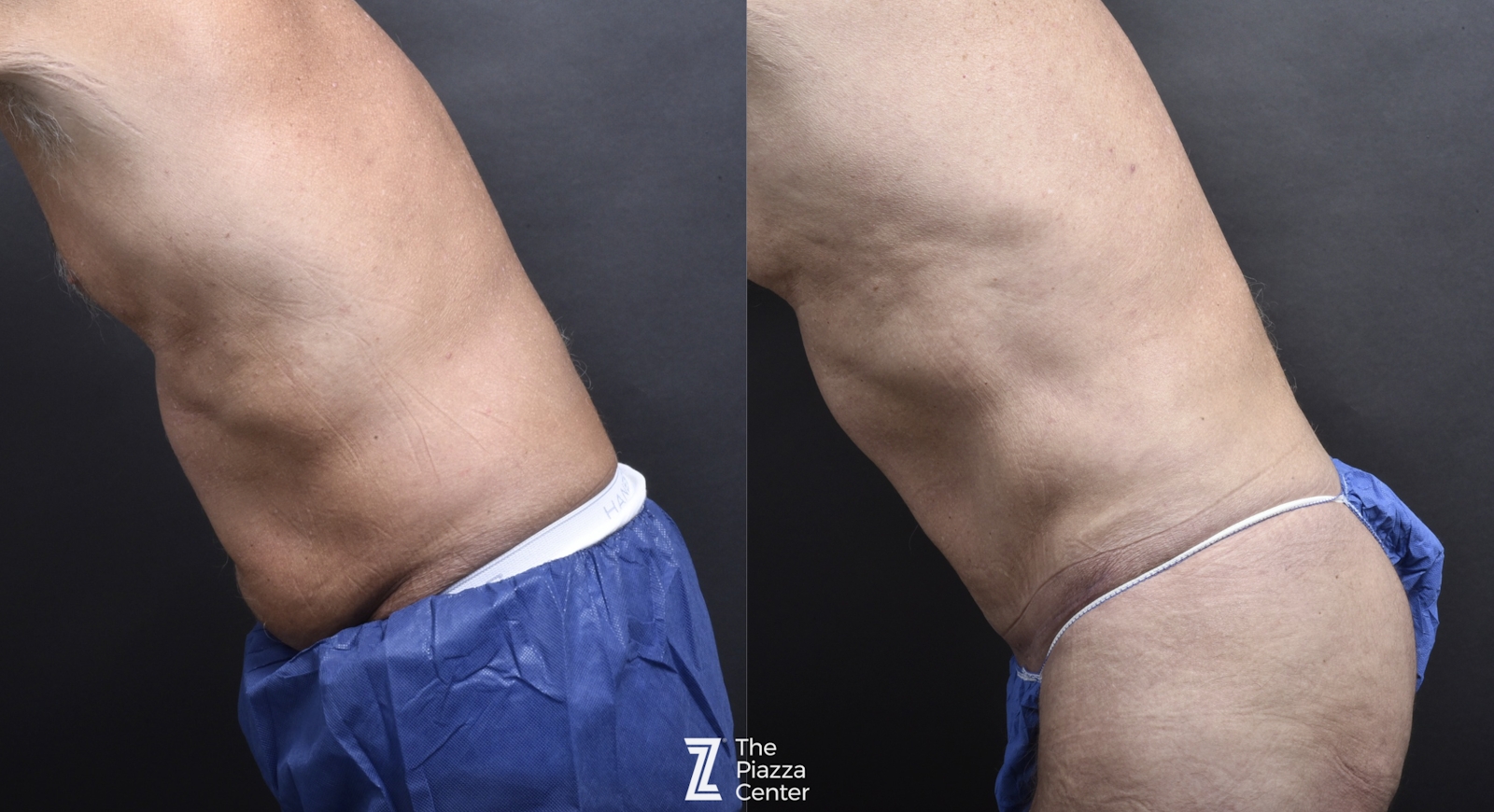 Austin Liposuction Before & After Gallery - Patient 182165 - Image 3 - The Piazza Center