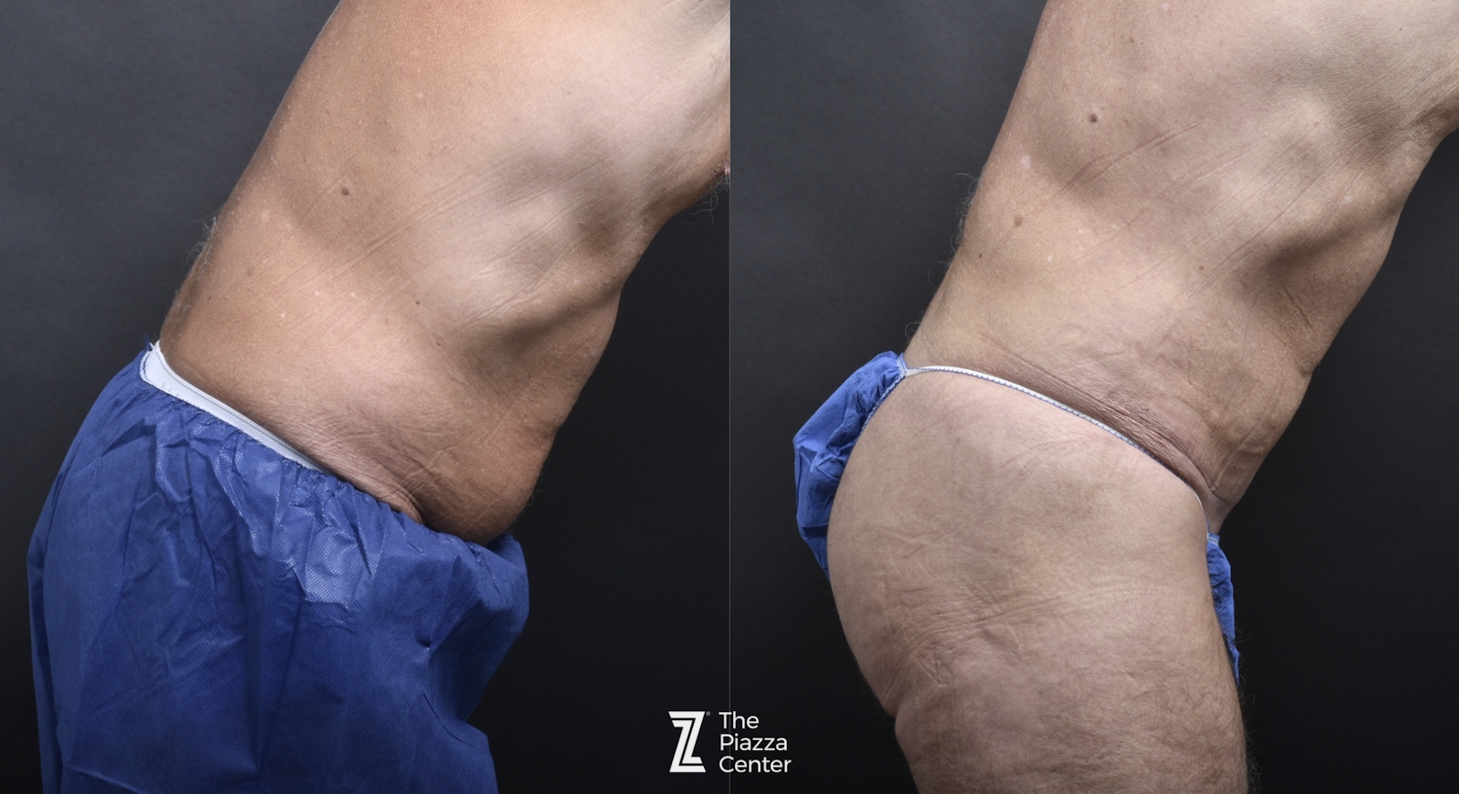 Austin Liposuction Before & After Gallery - Patient 182165 - Image 2 - The Piazza Center