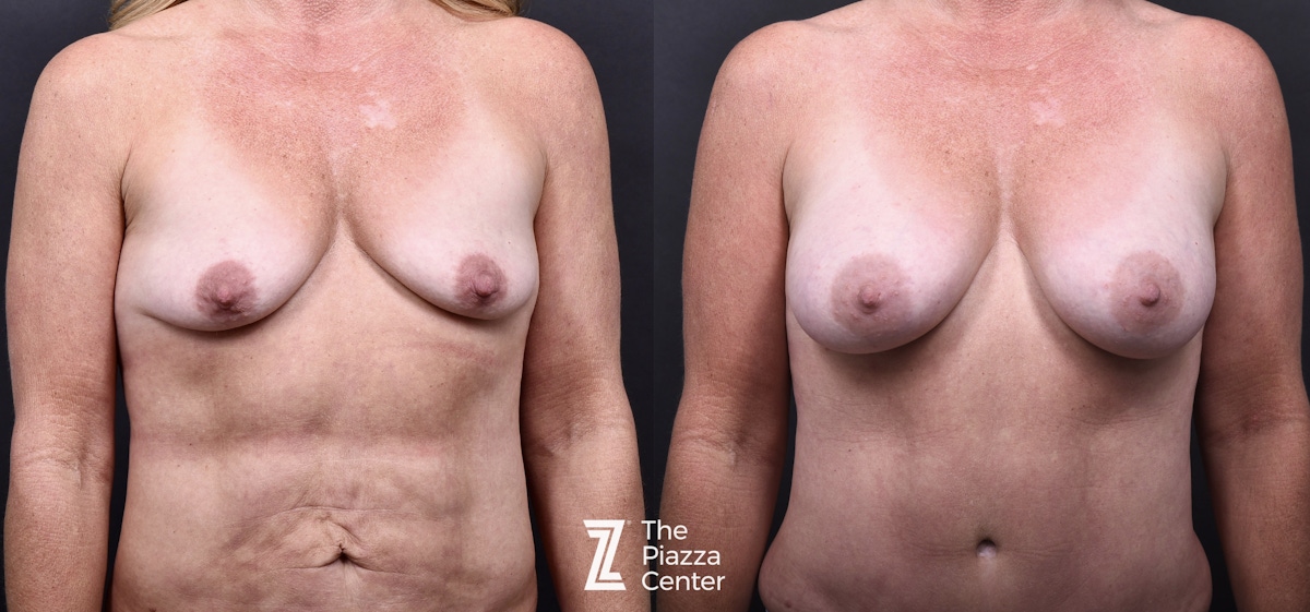 Austin Breast Augmentation Before & After Gallery - Patient 158035 - Image 1 - The Piazza Center