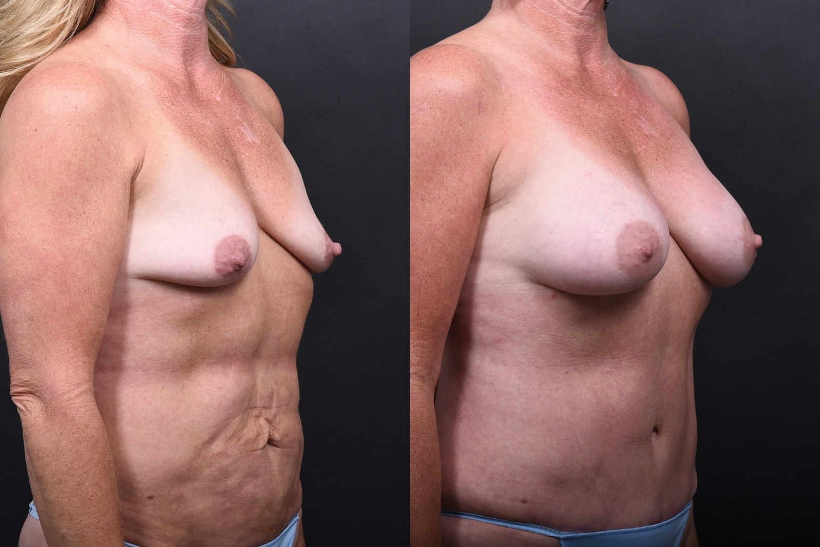 Austin Liposuction Before & After Gallery - Patient 311956 - Image 4 - The Piazza Center