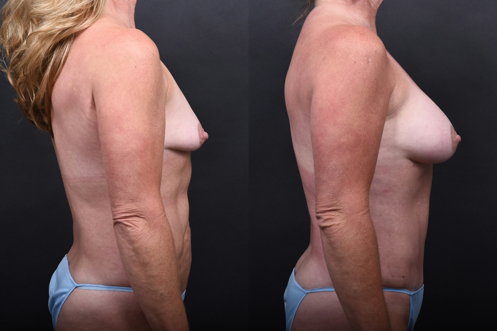 Austin Liposuction Before & After Gallery - Patient 311956 - Image 5 - The Piazza Center