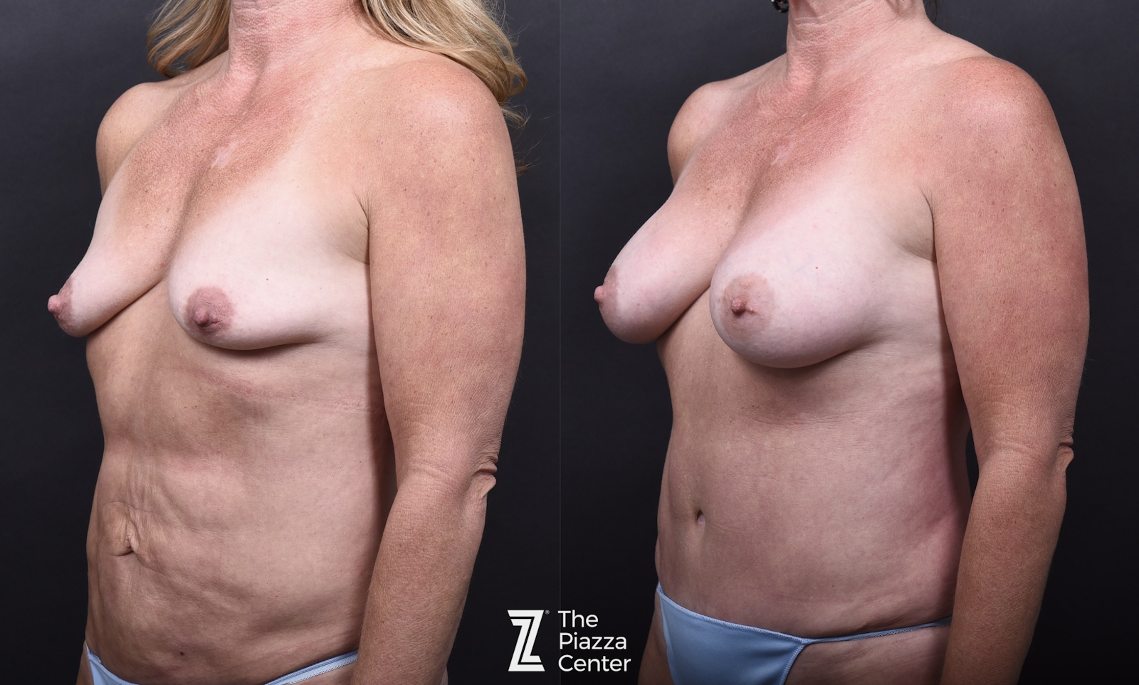 Austin Liposuction Before & After Gallery - Patient 311956 - Image 6 - The Piazza Center