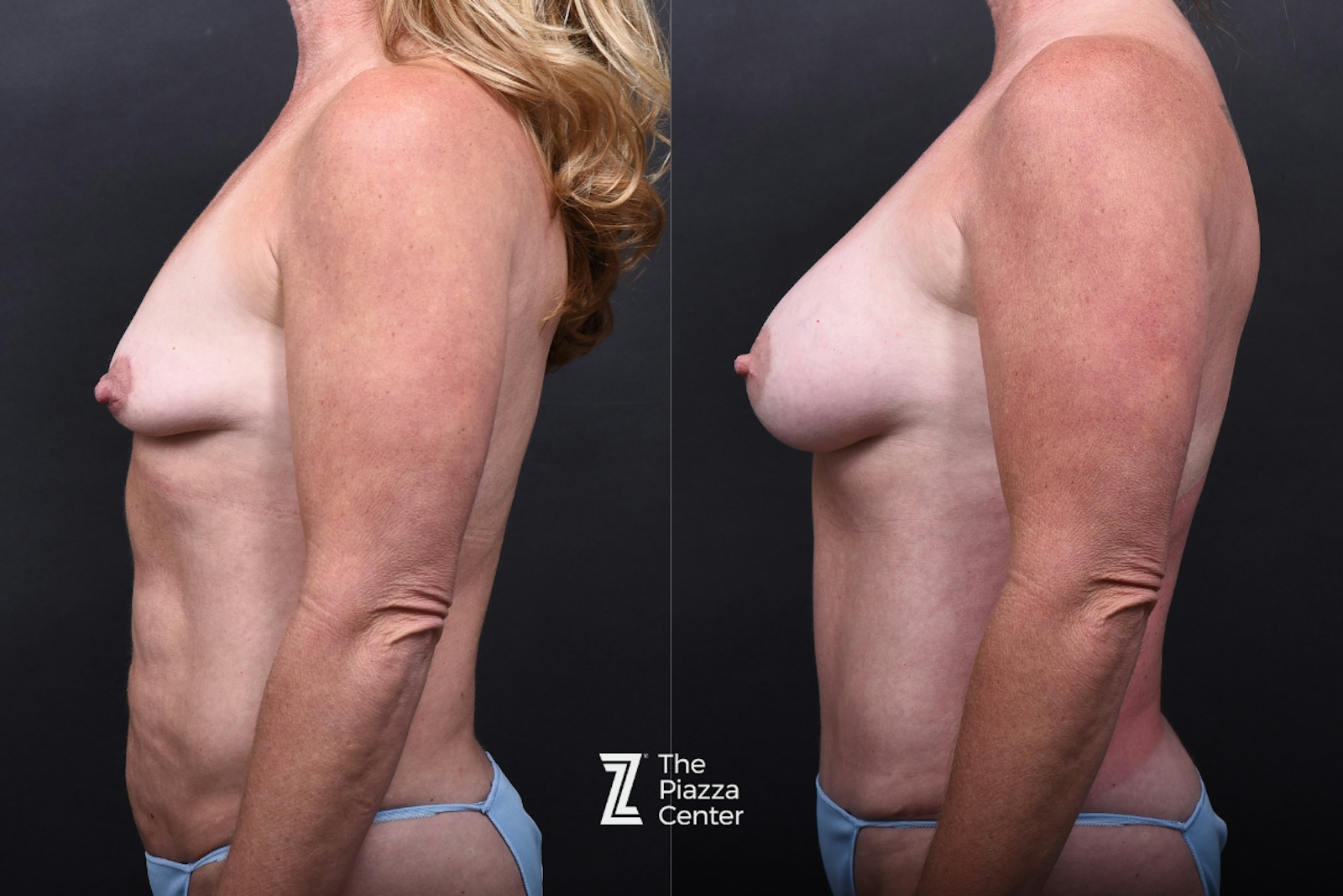 Austin Liposuction Before & After Gallery - Patient 311956 - Image 7 - The Piazza Center