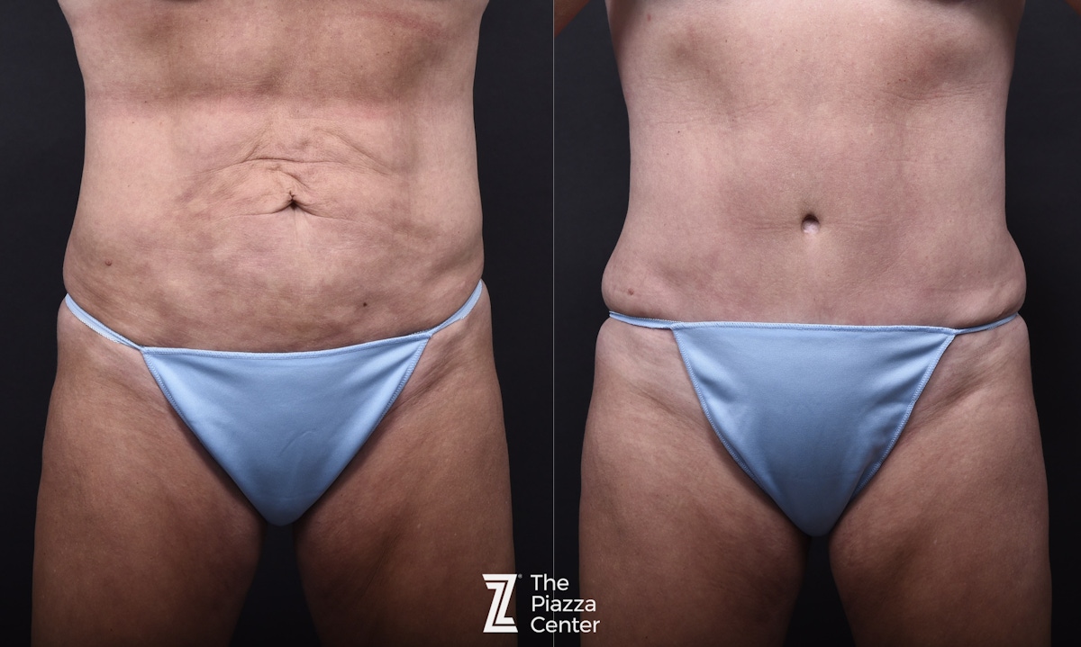 Austin Liposuction Before & After Gallery - Patient 311956 - Image 1 - The Piazza Center