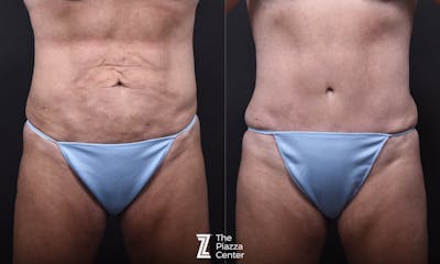 Austin Liposuction Before & After Gallery - Patient 311956 - Image 1 - The Piazza Center