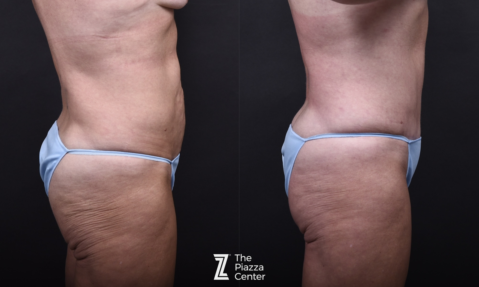 Austin Liposuction Before & After Gallery - Patient 311956 - Image 2 - The Piazza Center