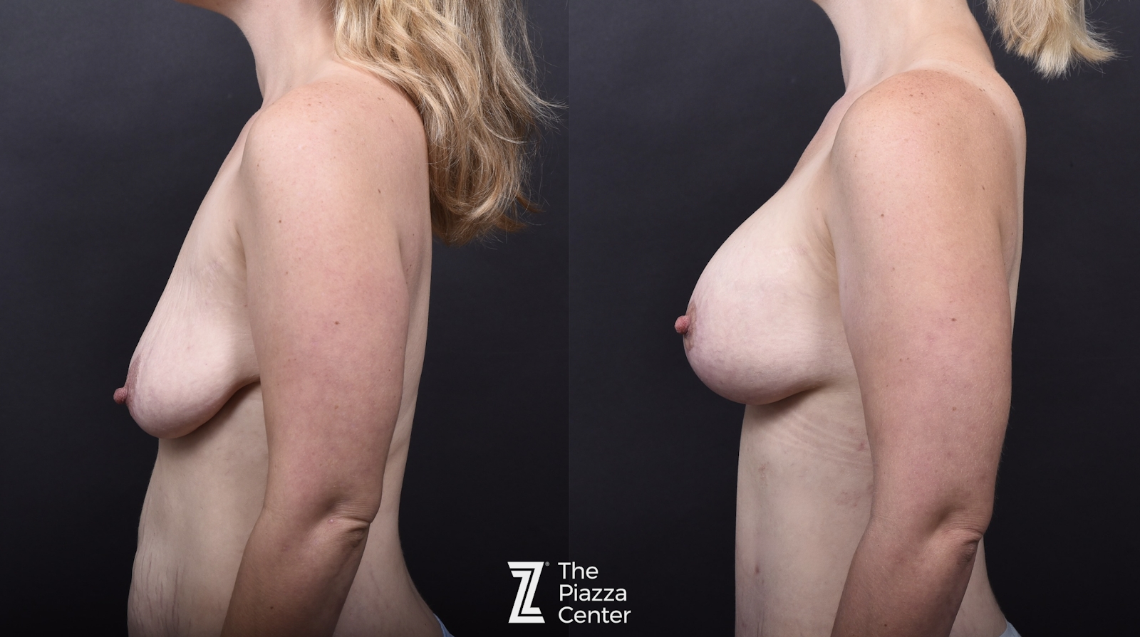 Austin Breast Augmentation Before & After Gallery - Patient 425278 - Image 5 - The Piazza Center