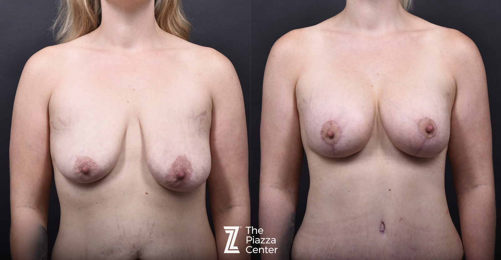 Austin Breast Augmentation Before & After Gallery - Patient 425278 - Image 1 - The Piazza Center