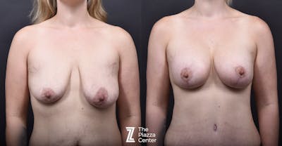 Austin Breast Augmentation With a Breast Lift Before & After Gallery - Patient 413161 - Image 1 - The Piazza Center