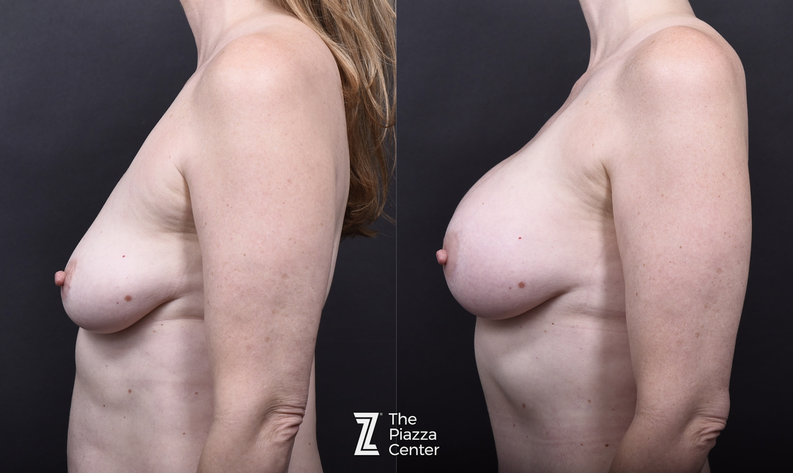 Austin Breast Augmentation Before & After Gallery - Patient 290644 - Image 3 - The Piazza Center