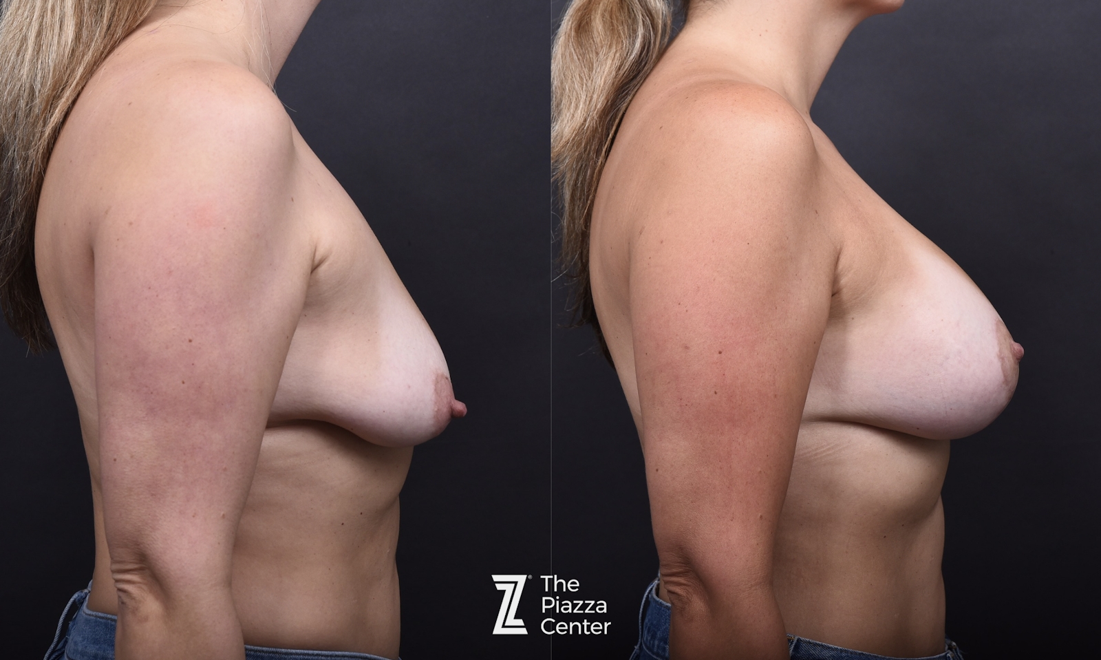 Austin Breast Augmentation With a Breast Lift Before & After Gallery - Patient 266420 - Image 3 - The Piazza Center