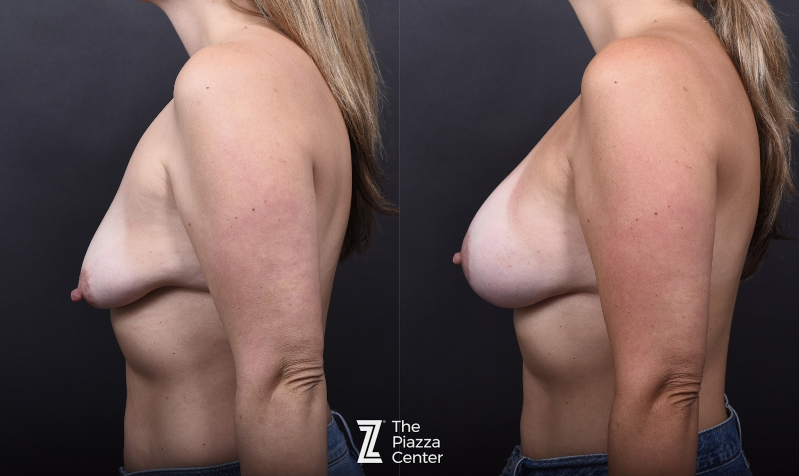 Austin Breast Augmentation With a Breast Lift Before & After Gallery - Patient 266420 - Image 5 - The Piazza Center