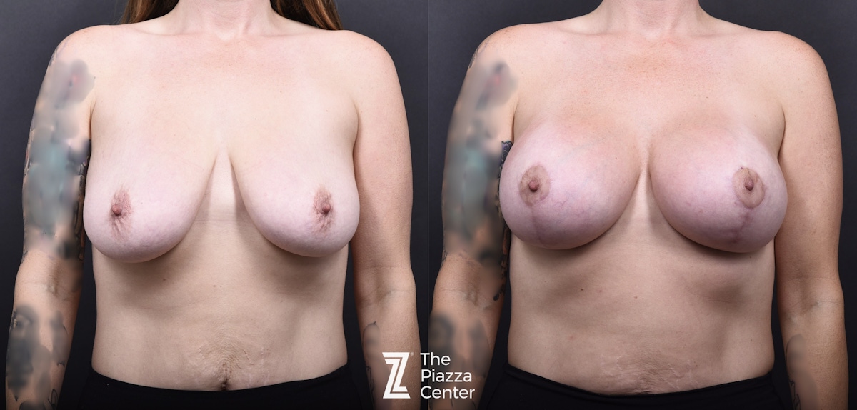 Austin Breast Augmentation Before & After Gallery - Patient 395673 - Image 1 - The Piazza Center