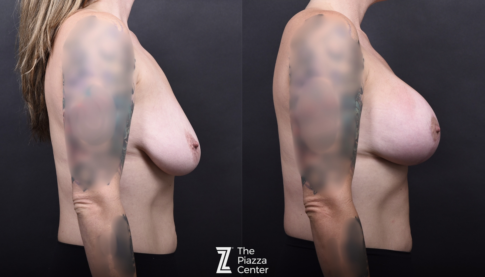 Austin Breast Augmentation Before & After Gallery - Patient 387998 - Image 3 - The Piazza Center