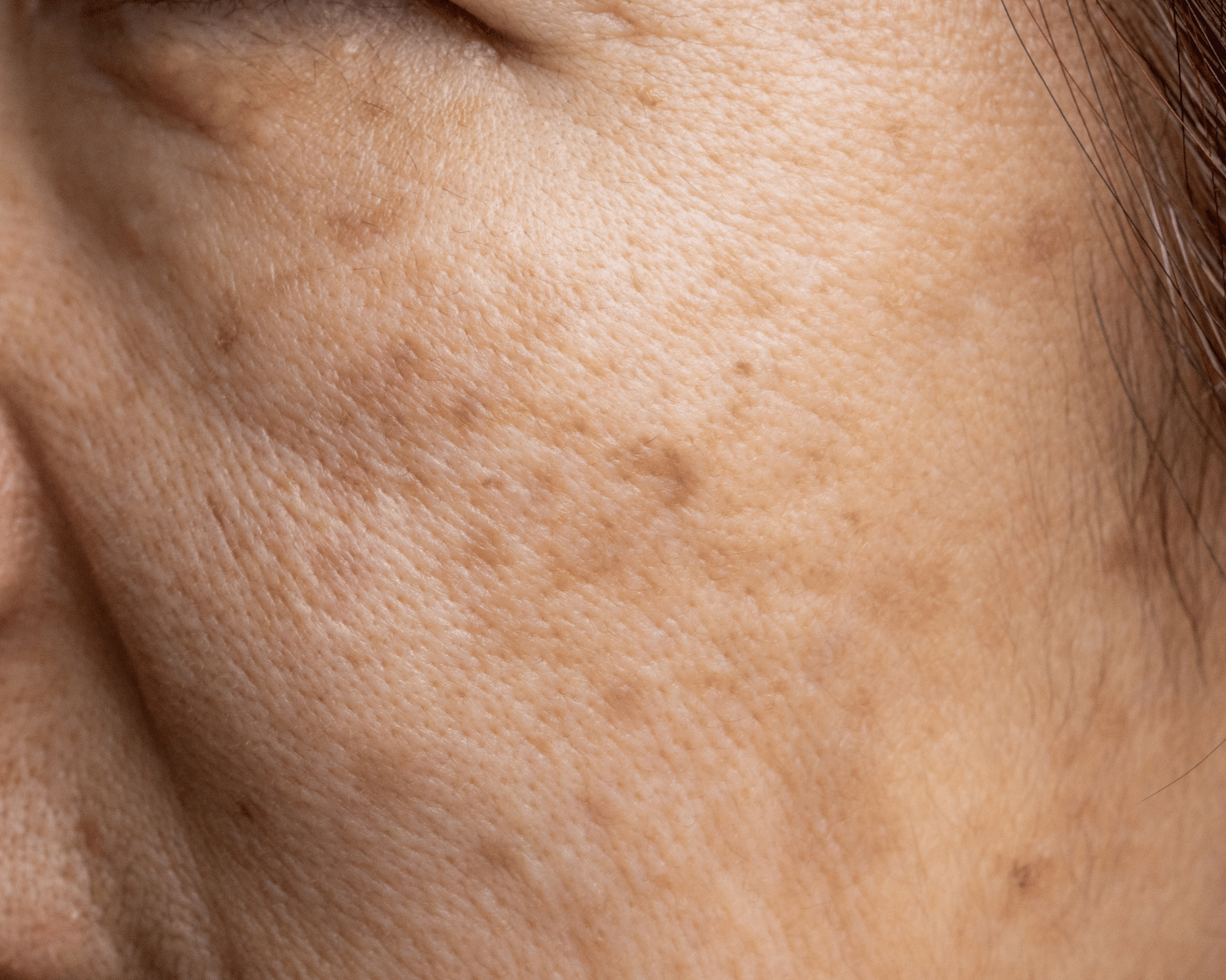 What is Melasma