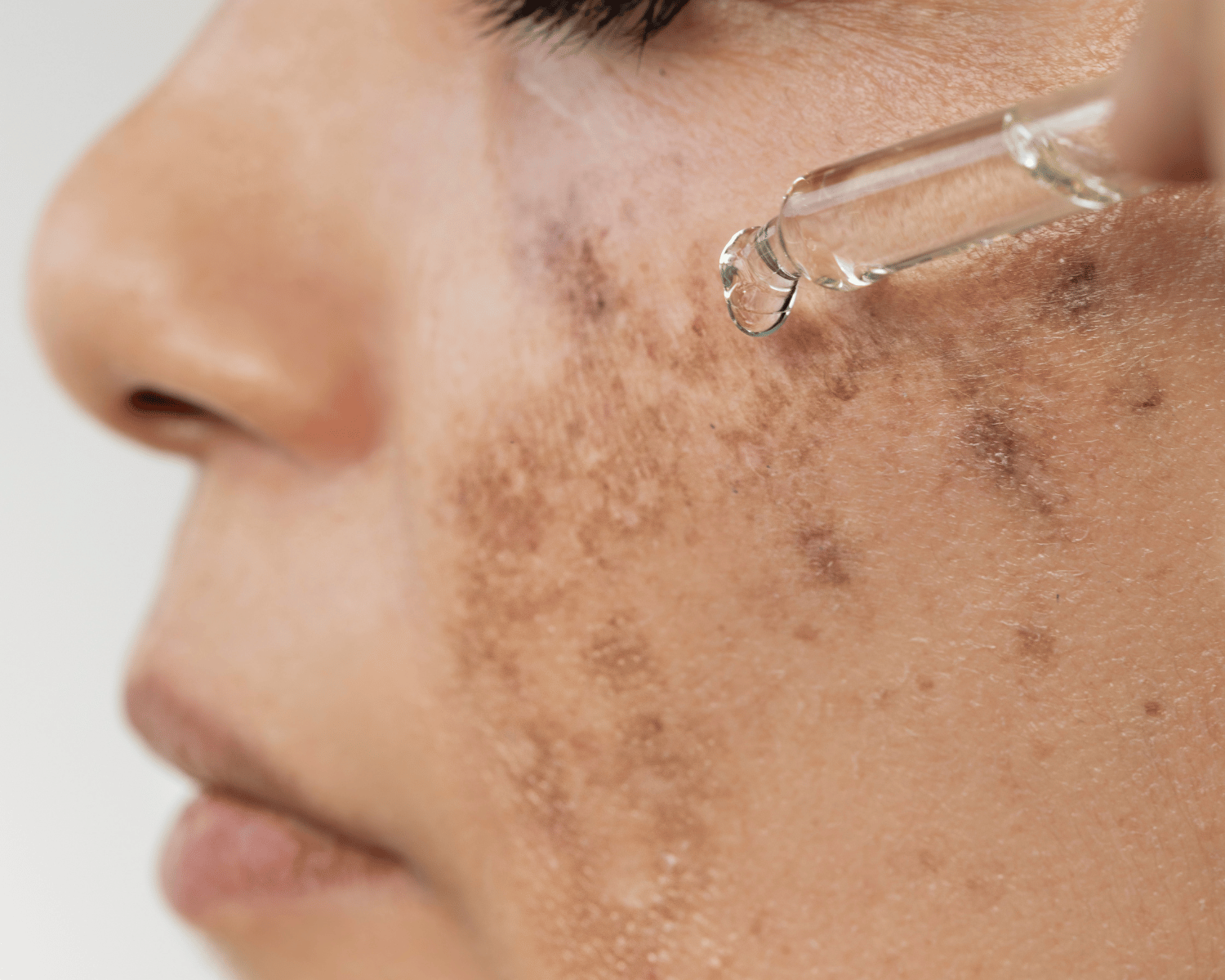 Best Skincare products for Melasma