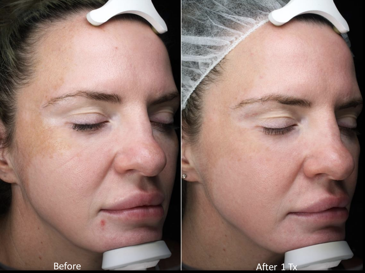 Moxi melasma treatment