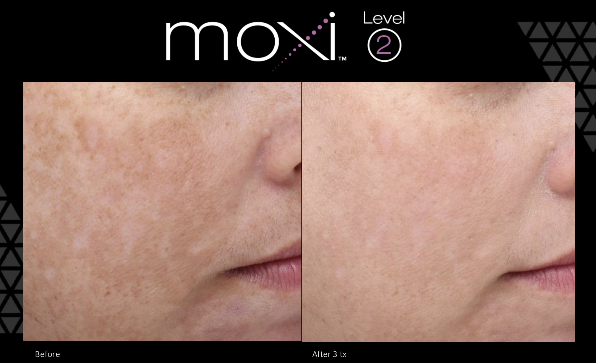 Moxi treatment Melasma