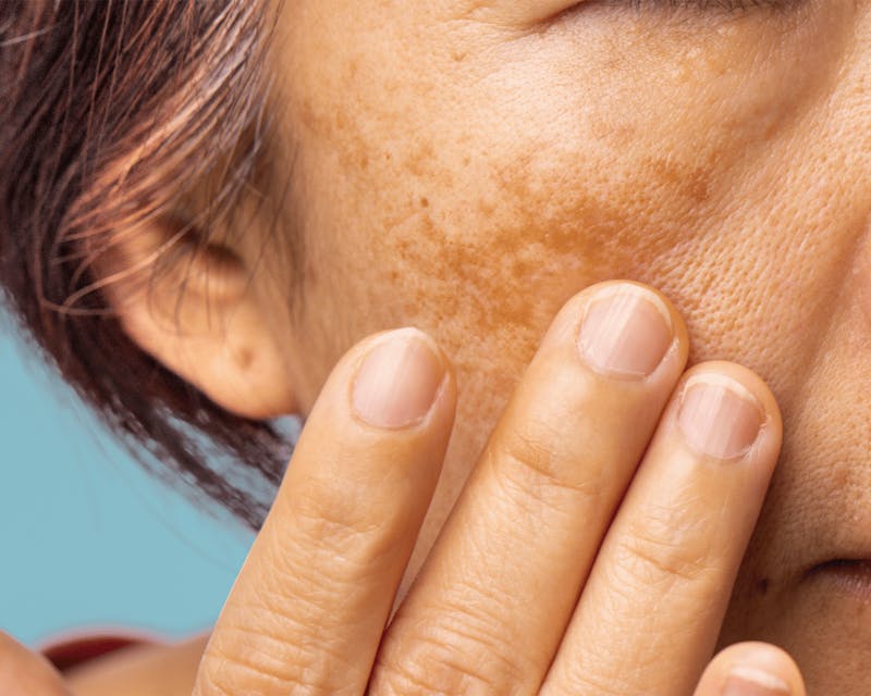 Treatments for Melasma in Austin