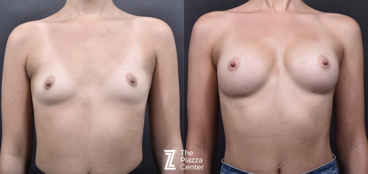 Austin Breast Augmentation Before & After Gallery - Patient 395673 - Image 1 - The Piazza Center