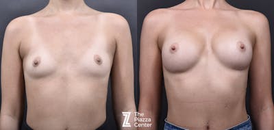 Austin Breast Augmentation Before & After Gallery - Patient 790705 - Image 1 - The Piazza Center