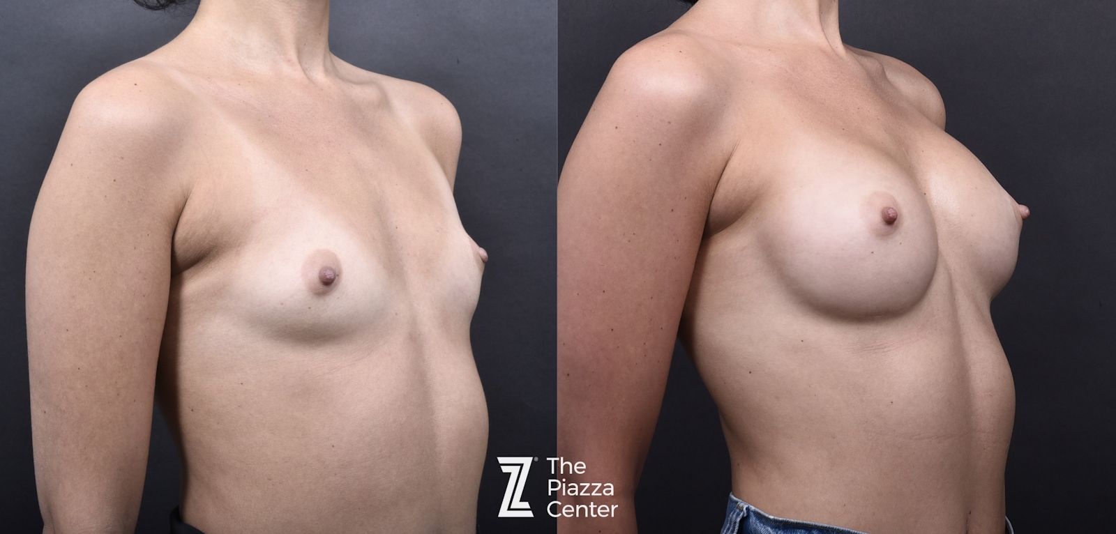 Austin Breast Augmentation Before & After Gallery - Patient 395673 - Image 2 - The Piazza Center