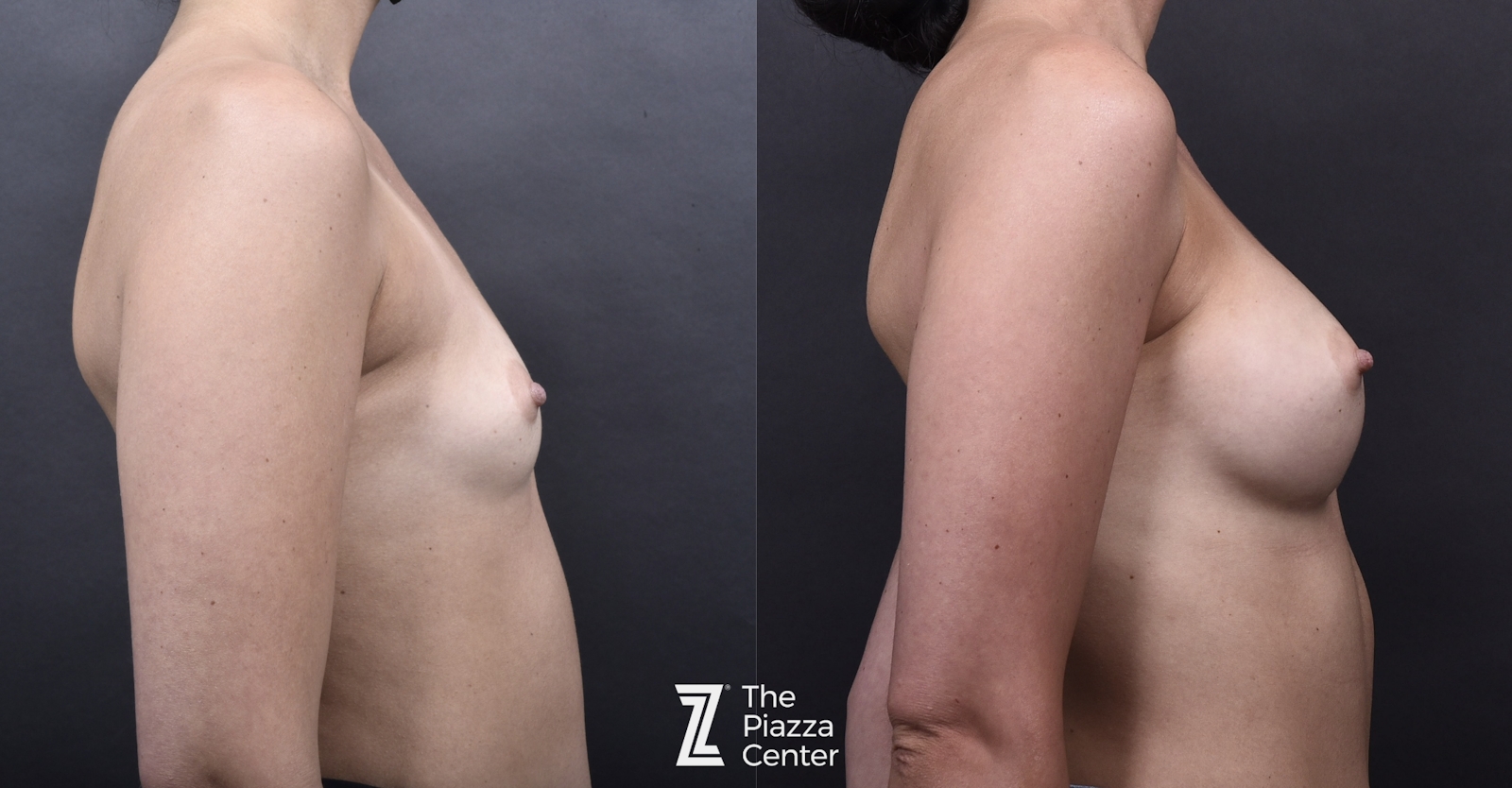 Austin Breast Augmentation Before & After Gallery - Patient 395673 - Image 3 - The Piazza Center