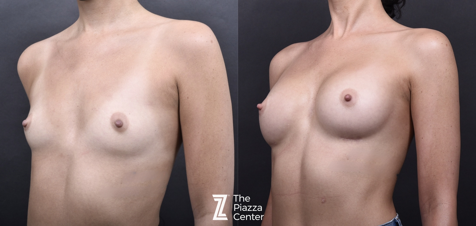 Austin Breast Augmentation Before & After Gallery - Patient 395673 - Image 4 - The Piazza Center
