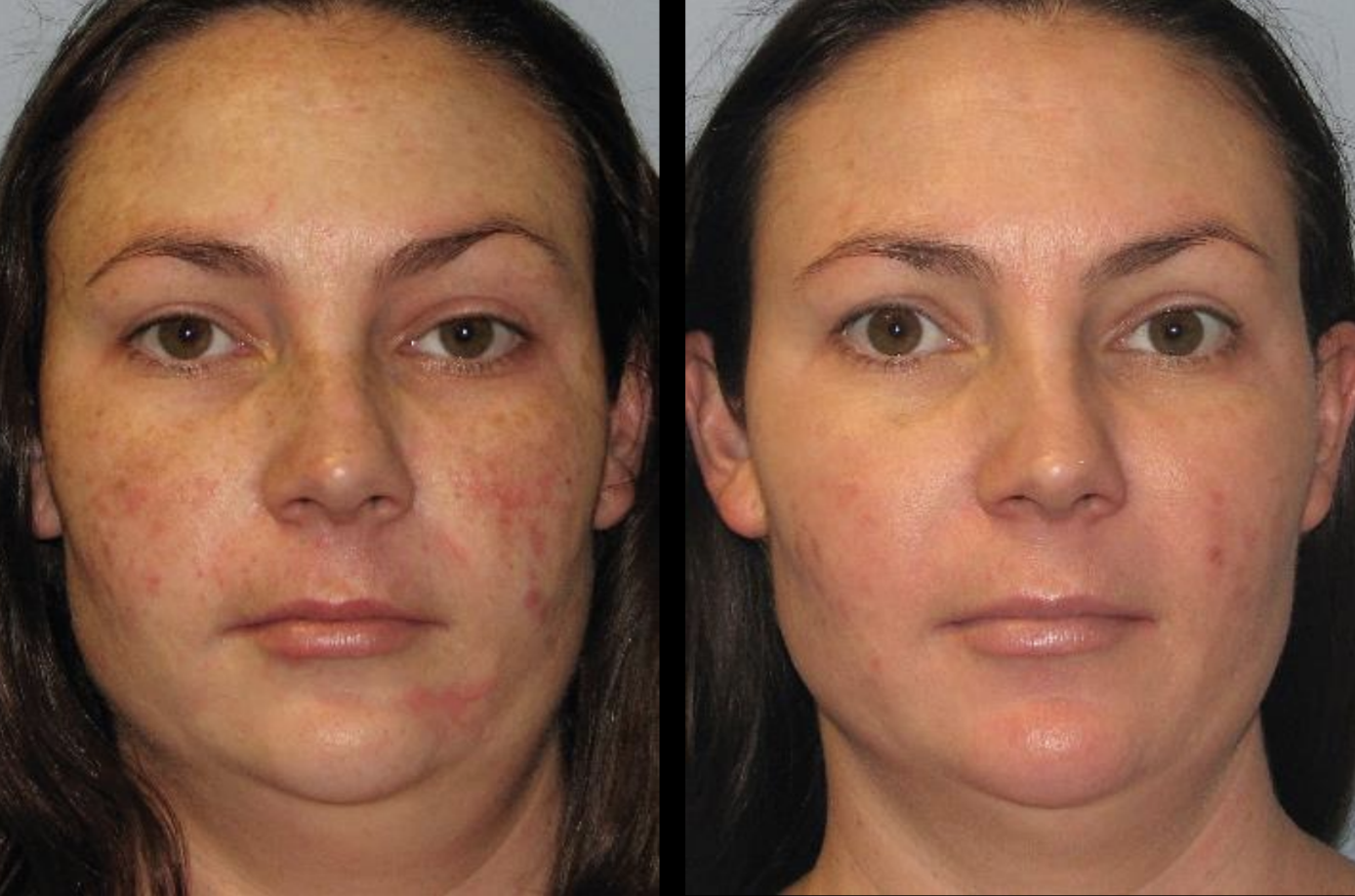 BBL Laser for Rosacea