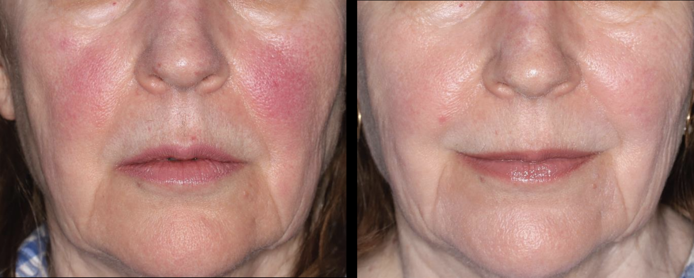 Rosacea BBL laser treatment