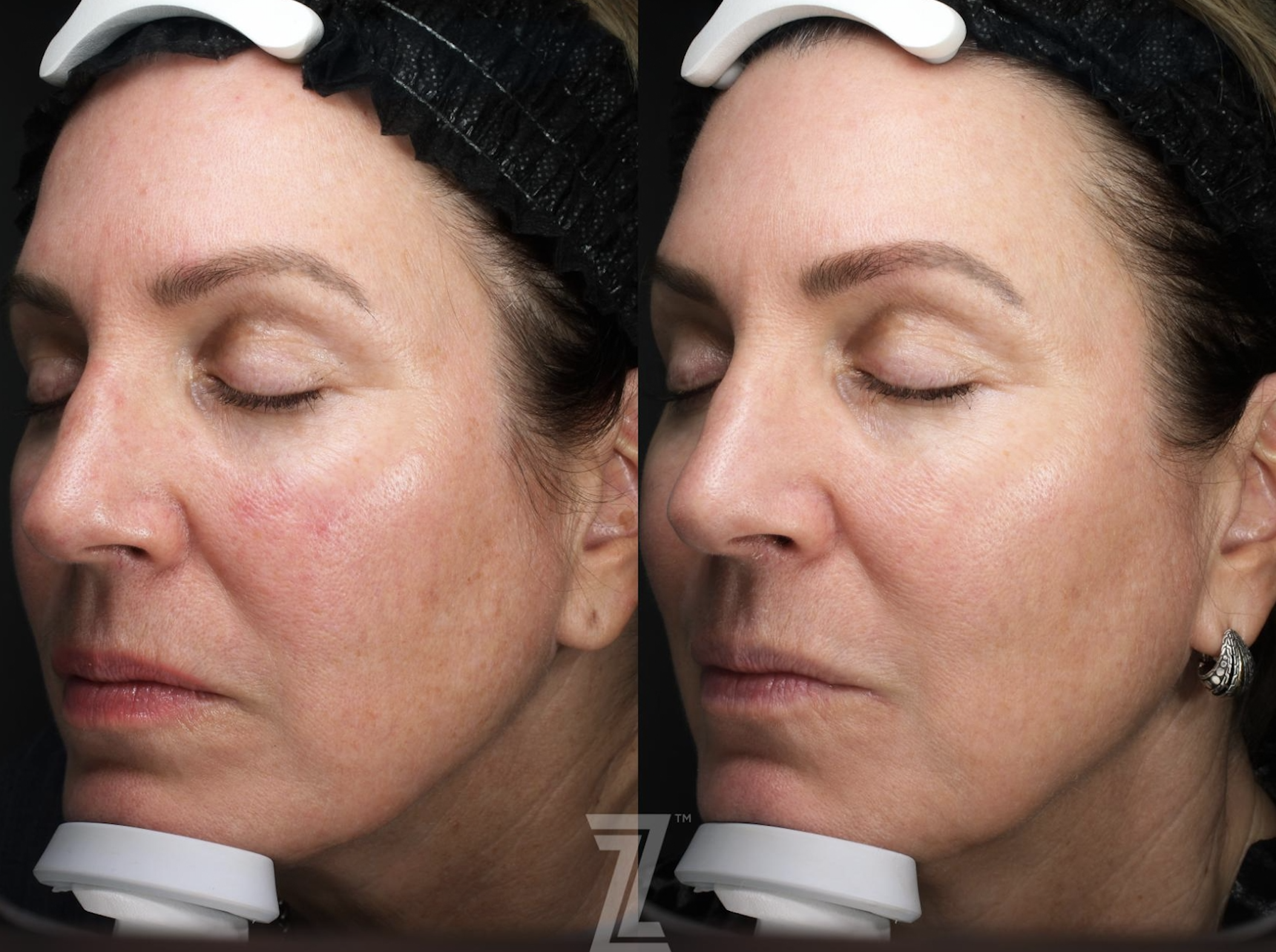 Rosacea treatment BBL Moxi Laser