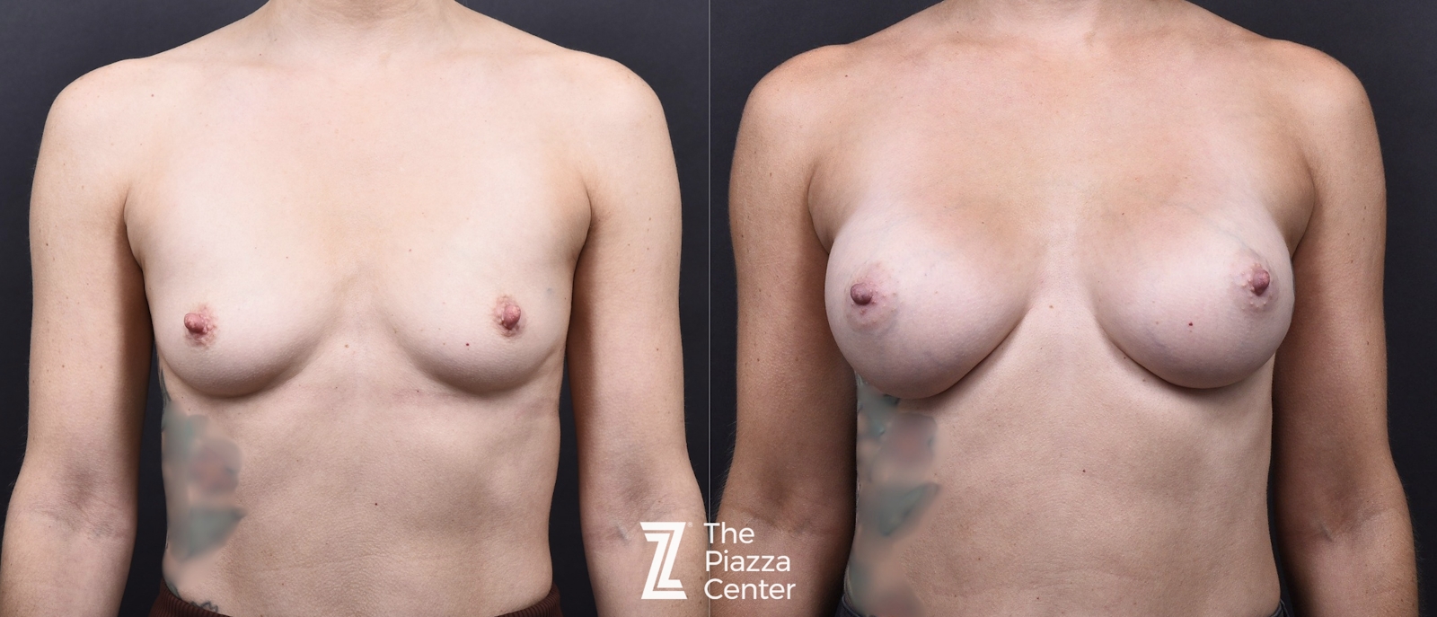 Austin Motiva Implants Before & After Gallery - Patient 657011 - Image 1 - The Piazza Center