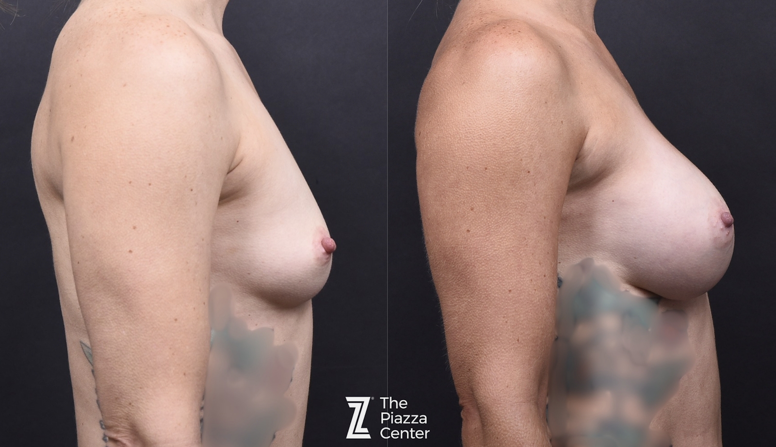 Austin Motiva Implants Before & After Gallery - Patient 657011 - Image 3 - The Piazza Center