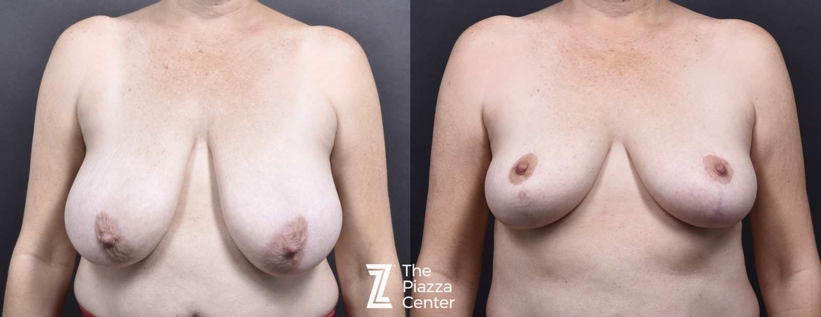 Austin Breast Lift Before & After Gallery - Patient 207229 - Image 1 - The Piazza Center
