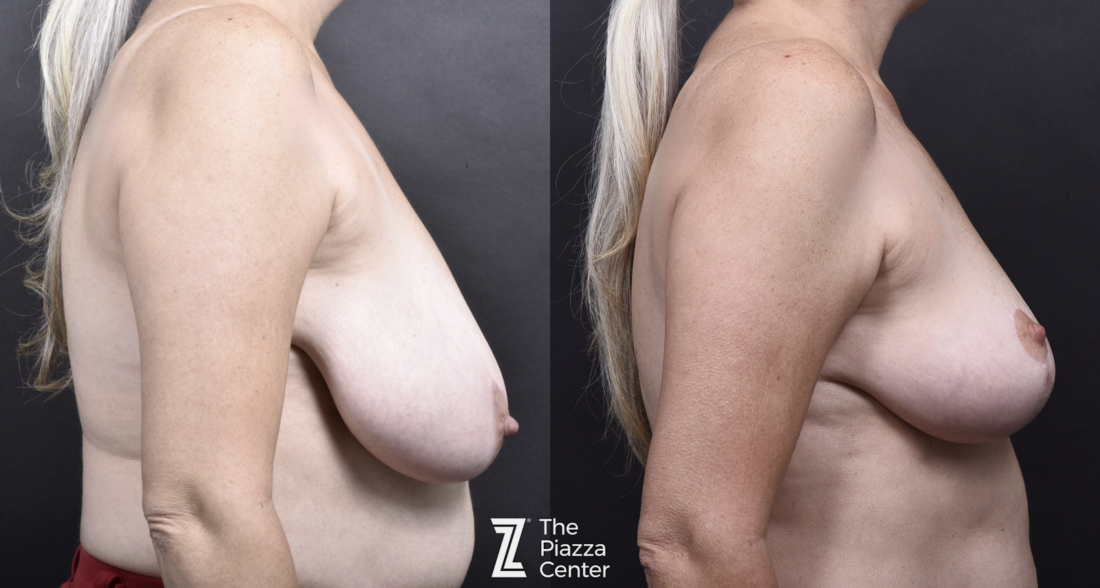 Austin Breast Lift Before & After Gallery - Patient 207229 - Image 3 - The Piazza Center