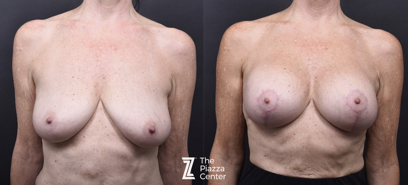 Austin Breast Augmentation With a Breast Lift Before & After Gallery - Patient 438571 - Image 1 - The Piazza Center