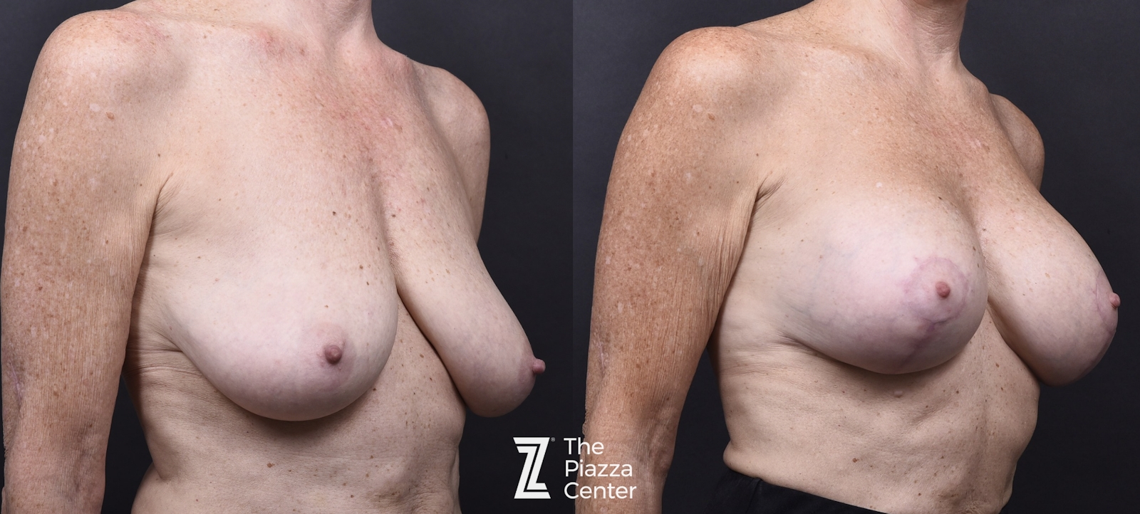 Austin Breast Augmentation With a Breast Lift Before & After Gallery - Patient 438571 - Image 2 - The Piazza Center