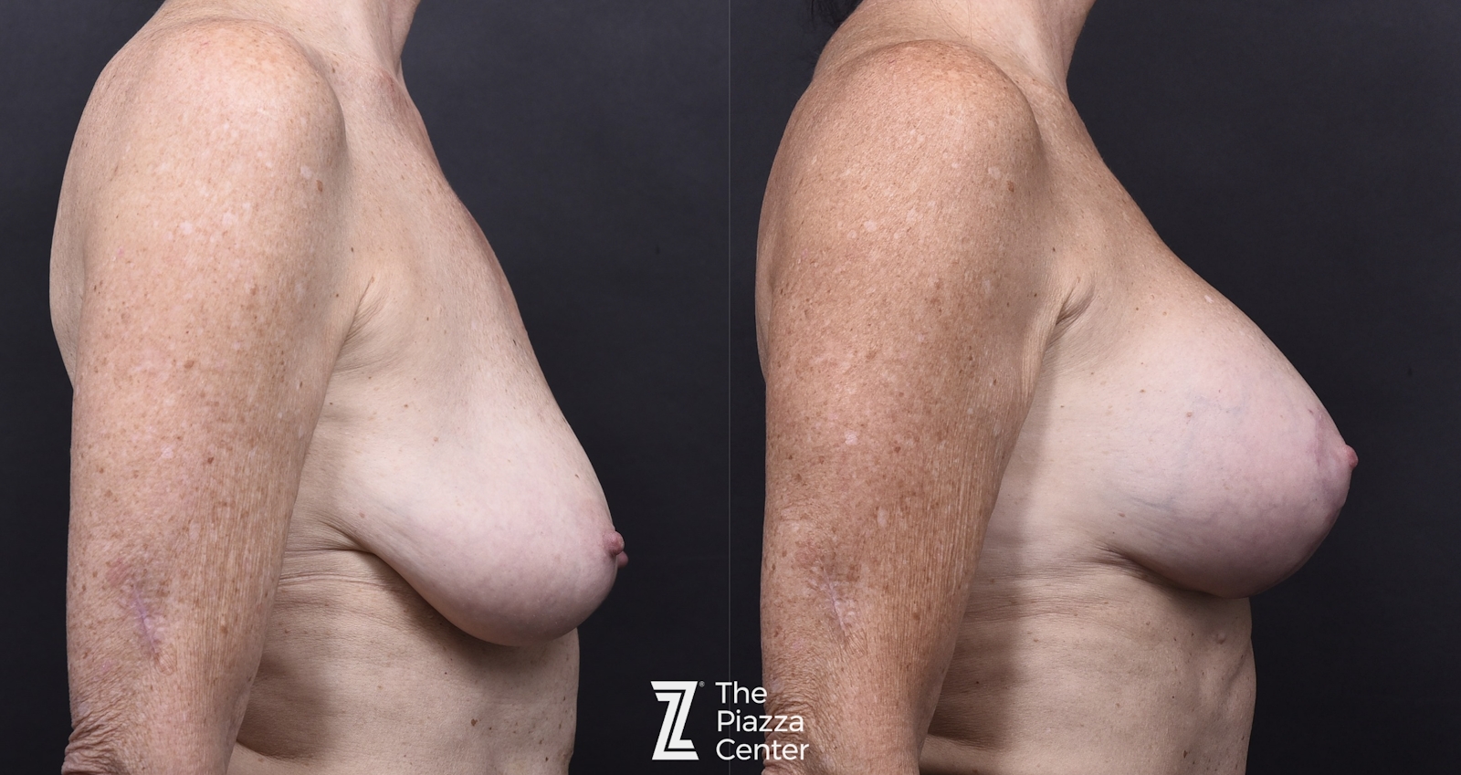 Austin Breast Augmentation With a Breast Lift Before & After Gallery - Patient 438571 - Image 3 - The Piazza Center