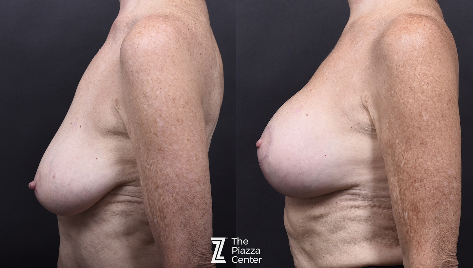 Austin Breast Augmentation With a Breast Lift Before & After Gallery - Patient 438571 - Image 5 - The Piazza Center