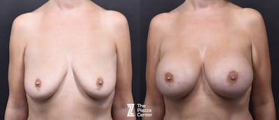 Austin Breast Augmentation Before & After Gallery - Patient 345874 - Image 1 - The Piazza Center