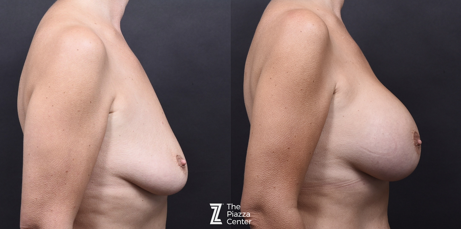 Austin Breast Augmentation Before & After Gallery - Patient 395673 - Image 3 - The Piazza Center