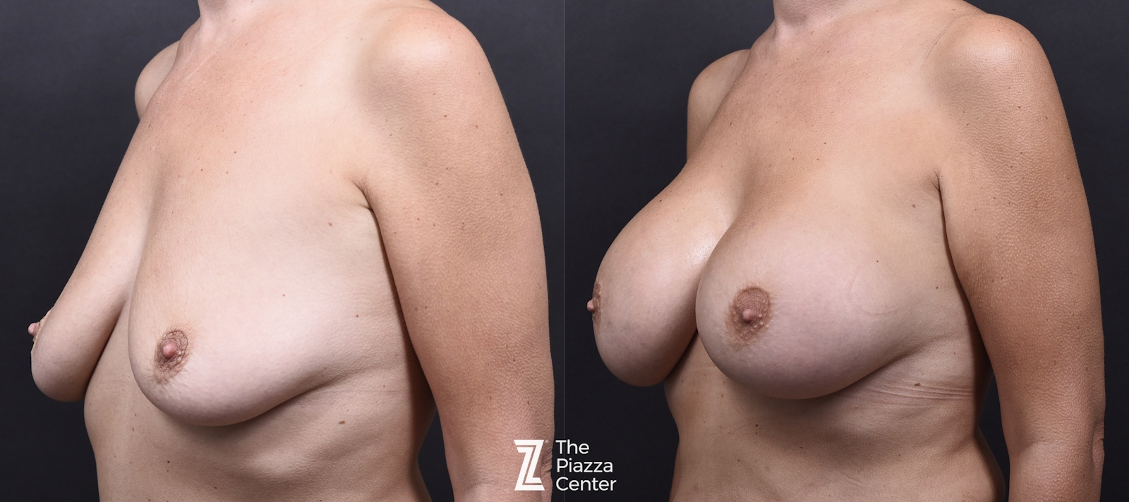 Austin Breast Augmentation Before & After Gallery - Patient 395673 - Image 4 - The Piazza Center