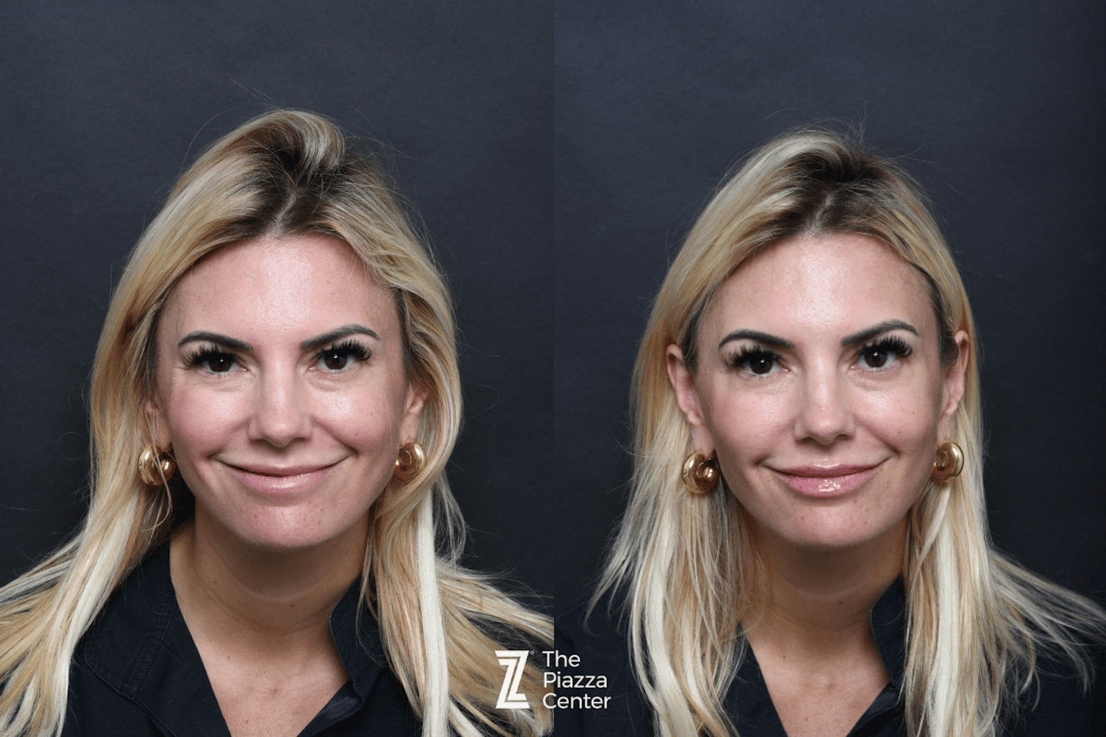 Austin Injectable Fillers Before & After Gallery - Patient 330475 - Image 2 - The Piazza Center