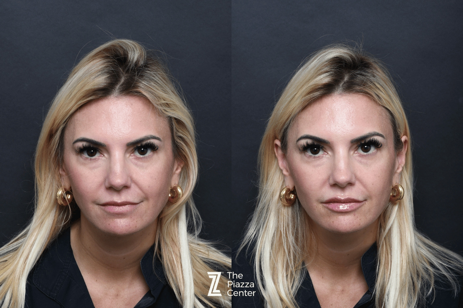 Austin Injectable Fillers Before & After Gallery - Patient 330475 - Image 1 - The Piazza Center