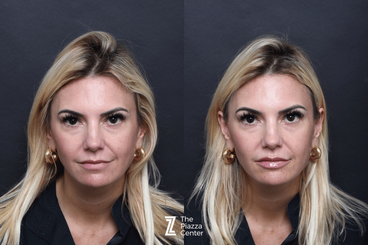 Austin Injectable Fillers Before & After Gallery - Patient 404245 - Image 1 - The Piazza Center
