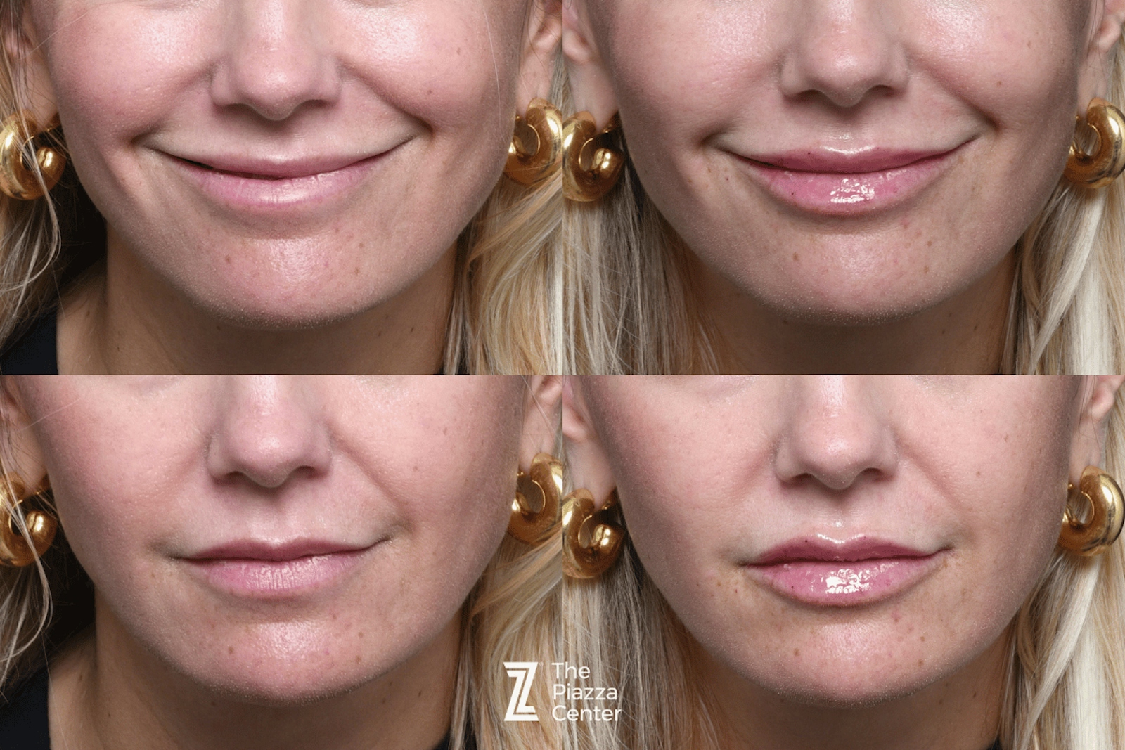 Austin Injectable Fillers Before & After Gallery - Patient 330475 - Image 3 - The Piazza Center
