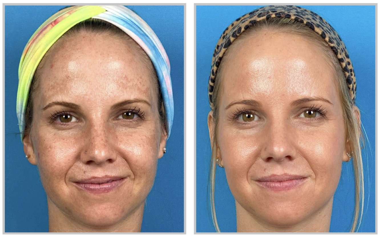 Before and After HALO