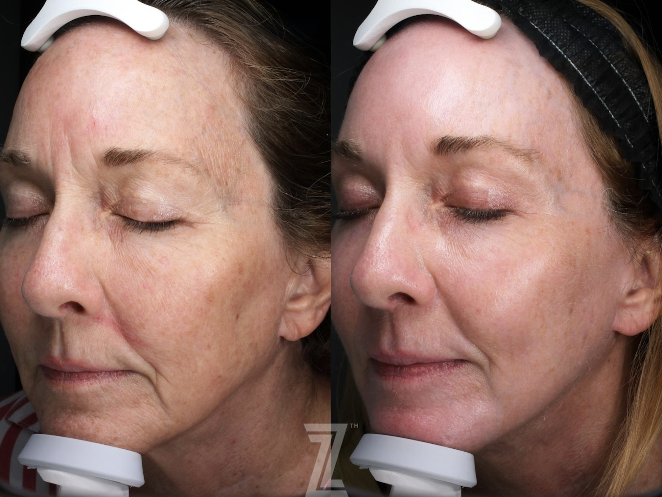 BBL Laser treatments
