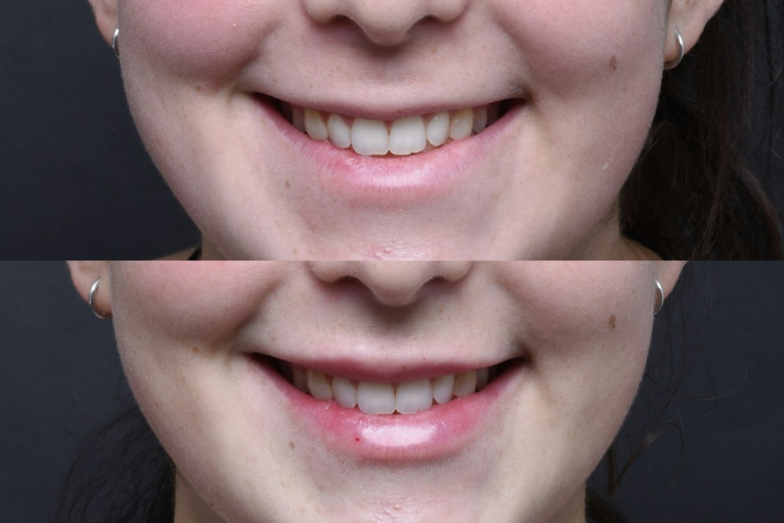 Austin Injectable Fillers Before & After Gallery - Patient 712627 - Image 2 - The Piazza Center
